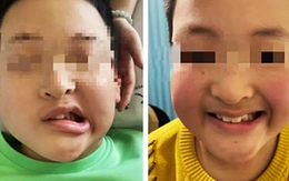 Bé trai 11 tuổi méo miệng do liệt dây thần kinh số VII, bác sĩ cảnh báo nguyên nhân thường gặp