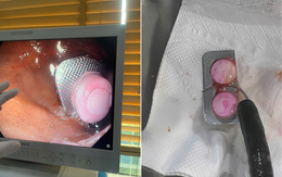 Bất cẩn nuốt thuốc "cả vỏ", người phụ nữ nhập viện vì thủng dạ dày