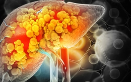 Phát hiện thói quen khiến gan "ngập" trong mỡ, nhiều người làm mỗi ngày: Không phải uống rượu bia