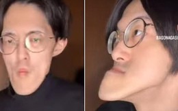 Người đàn ông có "chiếc cằm dài nhất thế giới", vẫn tiếp tục dài ra