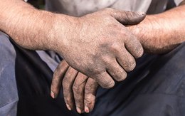 Giảm "phí tổn da liễu" cho mọi người: Giải pháp không corticoid giá hợp lý