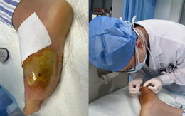 Suýt mất cả bàn chân vì giẫm phải cây tăm