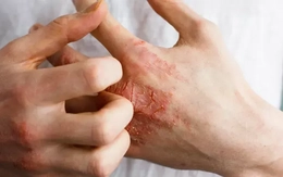 Câu chuyện về nỗi ám ảnh ‘nửa sống nửa chết’ vì loại thuốc hàng triệu người tin dùng Câu chuyện về nỗi ám ảnh ‘nửa sống nửa chết’ vì loại thuốc hàng triệu người tin dùng