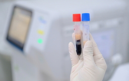 29 tuổi, mỡ máu cao vút dù ăn uống khoa học, cân nặng bình thường: Không ngờ lý do là điều này