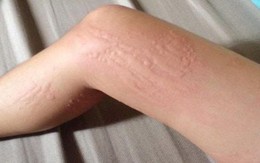 Dị ứng thời tiết: Vì sao bạn bị ngứa, nổi mẩn mỗi khi giao mùa?