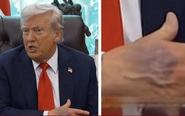 Bàn tay thâm tím của ông Trump gây chú ý