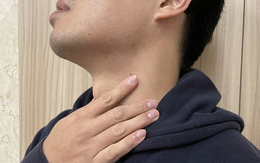 Uống 5 lon nước ngọt mỗi ngày, nam thanh niên trào ngược dạ dày 98 lần