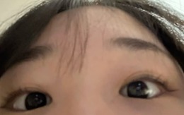 MẮT cũng có thể UNG THƯ! Nếu có 5 dấu hiệu này tức là võng mạc đang "giấu" khối u