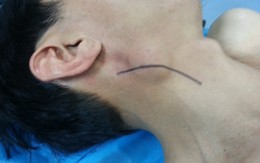 Loại ung thư có thể xuất hiện ở bất cứ vị trí nào trên cơ thể, không để ý 5 dấu hiệu này dễ "hối không kịp"