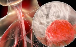 Nam giám đốc bất ngờ phát hiện ung thư giai đoạn 3: Hối hận vì đã bỏ qua 1 dấu hiệu suốt nhiều năm