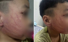 Xôn xao hình ảnh bé trai ở Hà Nội bị đánh tím mặt, phụ huynh phẫn nộ tố đích danh giáo viên