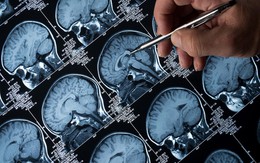 “Amip ăn não” lan rộng tại một bang ở Ấn Độ, tỷ lệ tử vong lên đến 97%