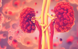 4 người trong 1 gia đình cùng mắc bệnh thận: Bác sĩ chỉ rõ nguyên nhân