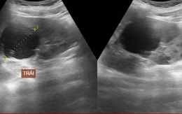 Nam sinh 15 tuổi khỏe mạnh đi khám phát hiện bị bệnh lý ba đời cùng mắc