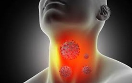 Cổ lên hạch tưởng bị viêm, người đàn ông bất ngờ phát hiện ung thư vòm họng giai đoạn 2: Các dấu hiệu hay bị xem thường