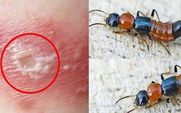 Kiến ba khoang "vào mùa", cẩn trọng dễ nhầm với zona thần kinh