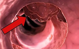 Khảo sát 522 người tử vong vì ung thư đại trực tràng phát hiện 3 điểm chung đáng chú ý
