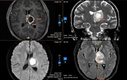 Thường xuyên buồn ngủ, đi khám “sốc” nặng khi biết nguyên nhân