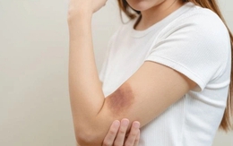 Muốn biết gan khỏe hay yếu, chỉ cần nhìn vào làn da sẽ rõ: Có 5 dấu hiệu này phải đi khám ngay