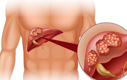 Cảnh báo từ WHO: 1 loại ĐỘC TỐ gây ung thư ẩn trong nhiều thực phẩm quen thuộc mà người Việt ĂN MỖI NGÀY