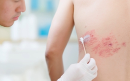 Chuyên gia cảnh báo: Hơn 90% người Việt Nam trưởng thành mang sẵn virus này, cứ 3 người thì có 1 người phát bệnh