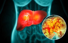 Không phải thịt mỡ, đây mới là "kẻ thù" số 1 của gan: Hóa ra là thứ vạn người mê mẩn