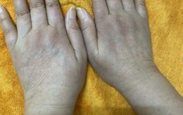 Nữ doanh nhân có 1 dấu hiệu lạ ở tay nhiều năm: Đi khám bác sĩ cảnh báo hàng loạt tạng đang "gặp nguy"