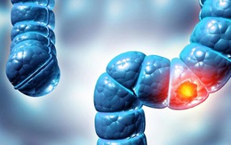 Phát hiện virus mới liên quan loại bệnh ung thư phổ biến