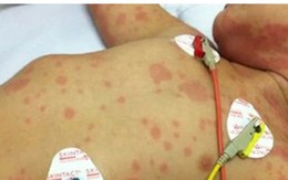 Ca bệnh do "sát thủ 24 giờ" não mô cầu gia tăng: Bác sĩ Bệnh viện Bạch Mai cảnh báo người lớn tuyệt đối không làm 1 việc khi ở gần trẻ