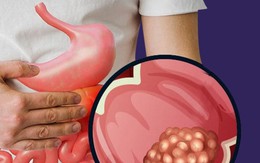 Phát hiện ung thư giai đoạn 4 ở tuổi 26, nam thanh niên hối hận: Giá như tôi không bỏ qua triệu chứng này