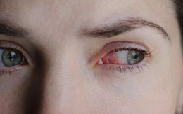 Chàng trai 24 tuổi mù đột ngột: Bác sĩ cảnh báo về thói quen mà nhiều người trẻ đang mắc mỗi tuần