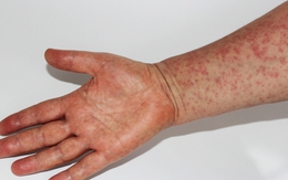 Dịch sởi lan rộng khiến hàng chục trẻ em tử vong, một quốc gia triển khai chiến dịch tiêm chủng khẩn cấp