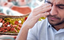 Nhìn vào mặt cũng có thể biết mỡ máu cao hay không: Nếu thấy 2 dấu hiệu này, hãy đi khám ngay