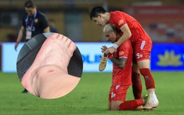 Đình Bắc lộ ảnh cổ chân sưng biến dạng sau trận vô địch V.League cùng CLB CAHN