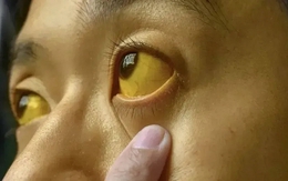 Nếu mắt có 6 thứ, đi khám ung thư ngay còn kịp!