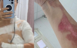 Đi gội đầu dưỡng sinh, cô gái nhận "combo sự cố": Bỏng độ 2, tự đi cấp cứu vì nồi xông hơi phát nổ?