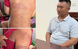 Vụ bé trai 10 tuổi người thâm tím nghi bị bạo hành: Lời khai của bố đẻ