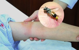 Bị ong đốt đừng vội hoảng: 7 thứ có sẵn trong nhà có thể giúp giảm sưng đau nhanh chóng, thứ đầu tiên hầu như ai cũng có