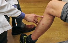 Các bác sĩ nói thẳng: Bắp chân là "đèn báo" đột quỵ, thấy 5 thứ phải đến bệnh viện ngay!
