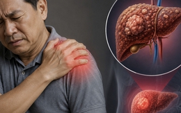 Cảnh báo 1 TÍN HIỆU cực quan trọng của ung thư gan: Nhiều người còn cố cãi chỉ đau vai thông thường