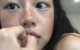 Bác sĩ chuyên khoa thận cay đắng thừa nhận: Dấu hiệu nguy hiểm nhất của suy thận không phải đau lưng dưới, mà là…