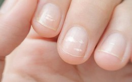 Ung thư có thể được phát hiện qua bàn tay? Bác sĩ cảnh báo: Xuất hiệu 5 dấu hiệu này, đừng nên chủ quan