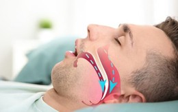 Ngáy to bị vợ giục đi khám, phát hiện căn bệnh có thể dẫn đến đột quỵ