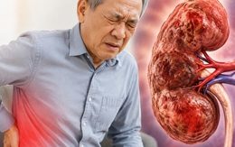 Bác sĩ chỉ: 6 DẤU HIỆU cảnh báo suy thận, nhưng dễ bị người Việt nhầm với vấn đề tuổi tác và mệt mỏi