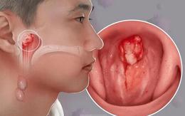 Con bị ù tai thôi mà... và cú sốc của gia đình khi bé trai 14 tuổi được chẩn đoán ung thư giai đoạn tiến triển