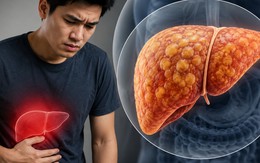 Gan nhiễm mỡ "ghé thăm" ngày càng nhiều người trẻ: Nếu có 7 THÓI QUEN này, bạn cần thay đổi ngay trước tuổi 40