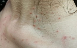 Cảnh báo: Các bệnh ung thư rất dễ "ngụy trang" dưới hình dạng của 4 loại mụn này