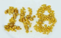 Lấy ra 248 viên sỏi từ túi mật chàng trai 26 tuổi có sở thích ăn uống "vạn người mê"