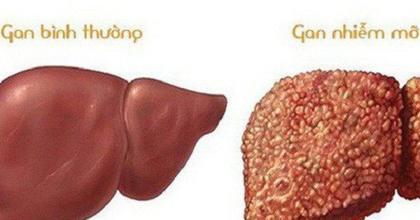 4 стадия печени сколько живут. Язык при циррозе печени.