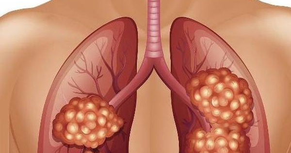 Tại sao phổi thô được coi là tình trạng bất thường? 
